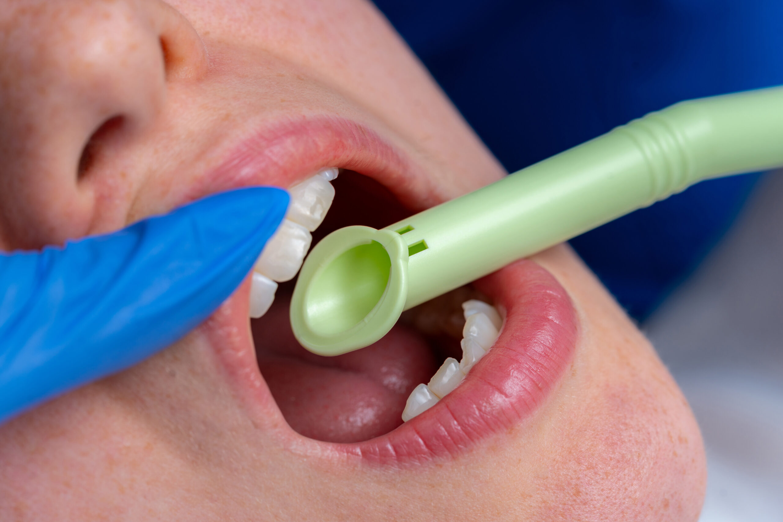 Hygo Jet Pro Bio in the mouth in the clinic